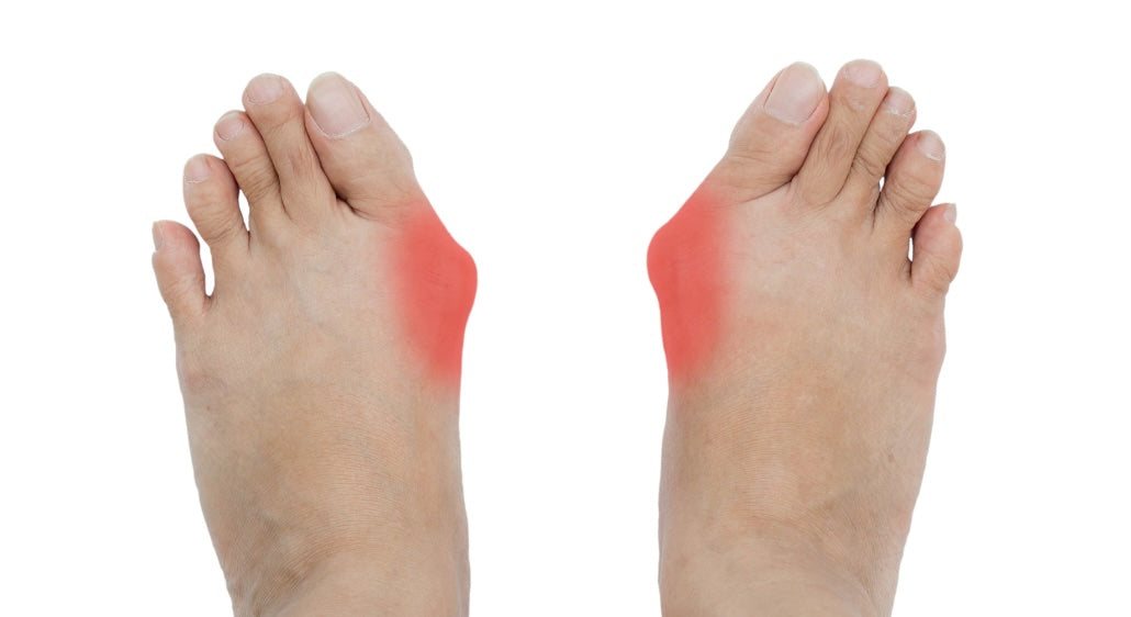 Bunion-1.jpg