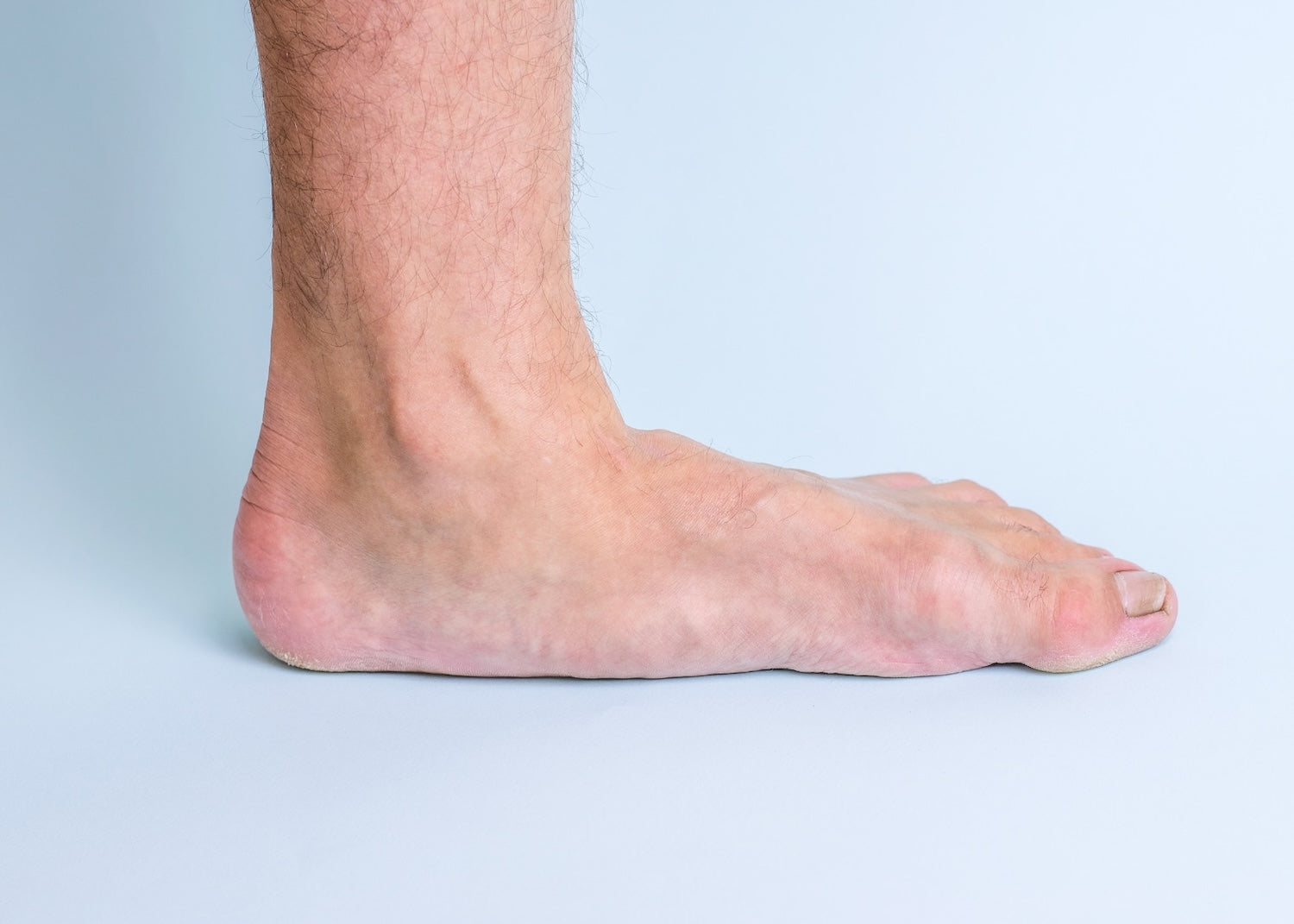 flat_feet_3_copy.jpg